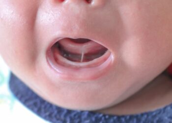 La Sociedad Española De Cirugía Oral Y Maxilofacial Y De Cabeza Y Cuello (SECOMCYC) Alerta De Un Elevado Número De Cirugías De Frenillo Lingual Innecesarias