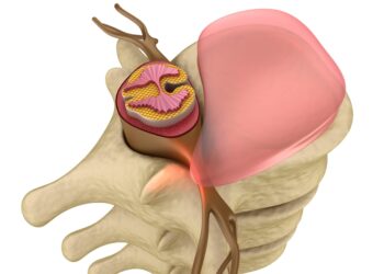 Medicina Regenerativa En Hernia Discal: Detrás De La Curación Mediante La Respuesta Inmunológica